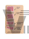 The model of spondyle pathology